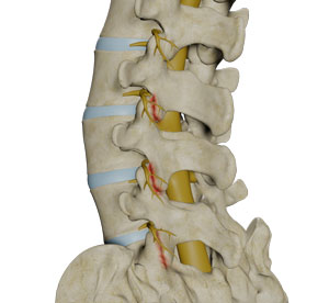 arthropathy