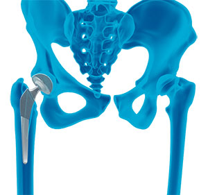 Correction of a Loose Hip Replacement