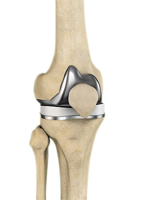 Correction of a Painful Knee Replacement