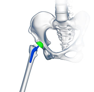 Custom/Patient-Specific Hip Replacement