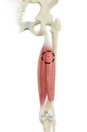 Hamstring Injuries