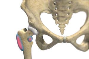 Trochanteric Bursitis - Plainsboro Township, NJ: Regenerative Spine and  Pain Institute