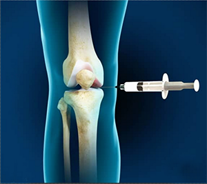 Intraarticluar Knee Injection