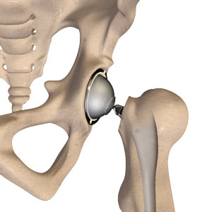 Direct Anterior Approach Hip Replacement Layton, Bountiful, Ogden, Salt  Lake City, Utah