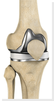 Outpatient / Same-Day Joint Replacement