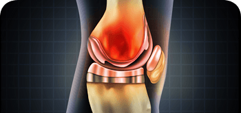 Outpatient/Same-Day Joint Replacement