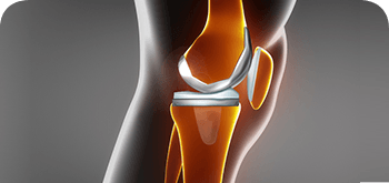 Rapid Recovery Joint Replacement